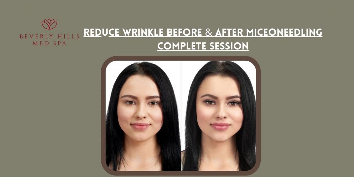 Reduce wrinkle Before & After Miceoneedling Complete Session