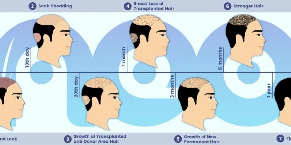 Hair Replacement in Turkey: The Ultimate Solution for Hair Loss